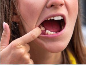 image of Pulled Tooth. Missing tooth.