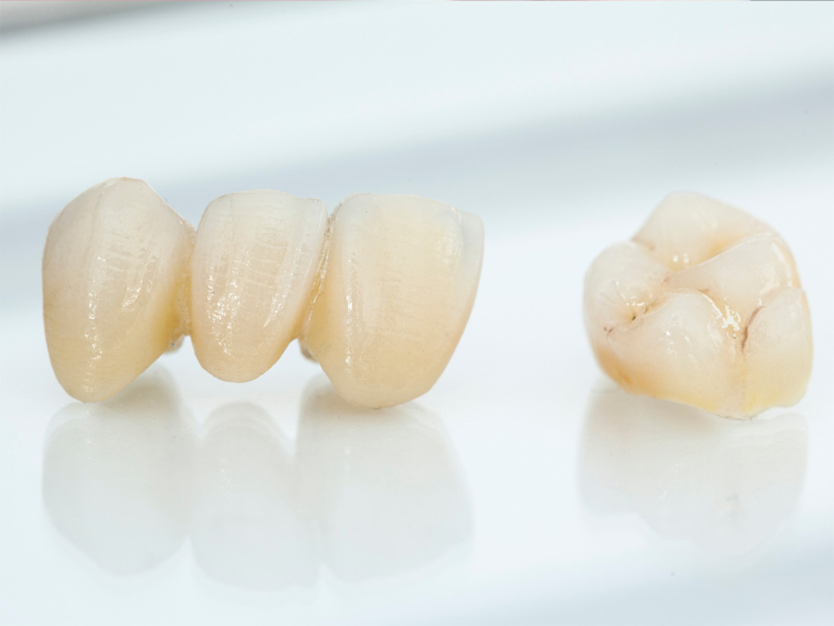 Implant Crowns image