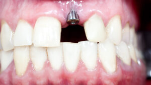 Close-up of dental implant with gum infection showing why some dental implants fail