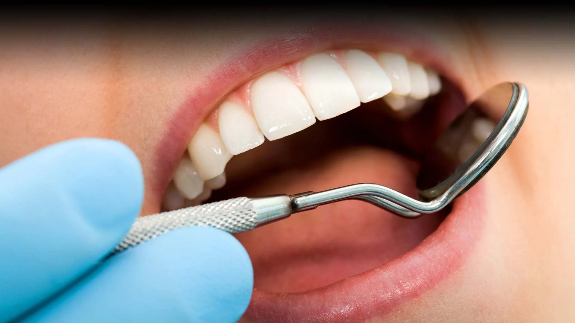 Cavity Prevention