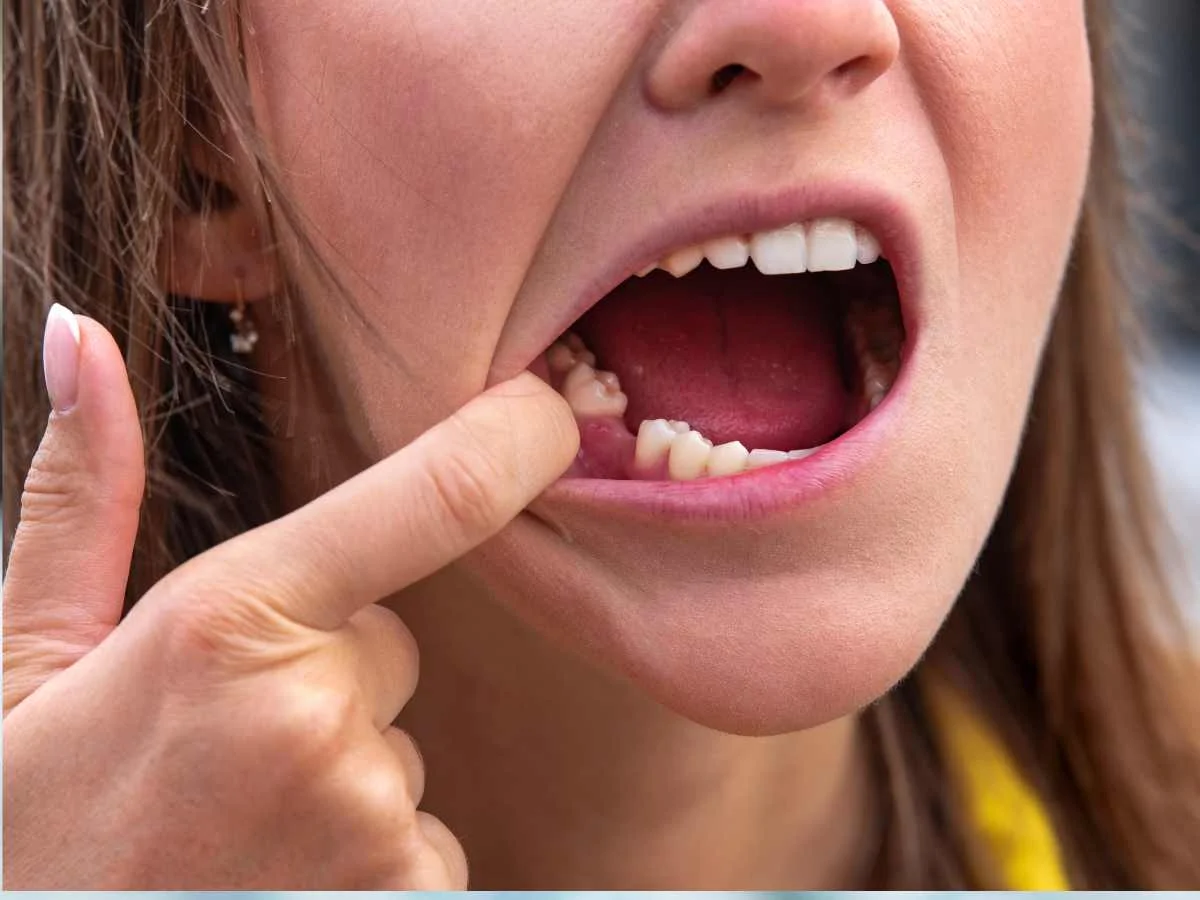 image of Pulled Tooth. Missing tooth.