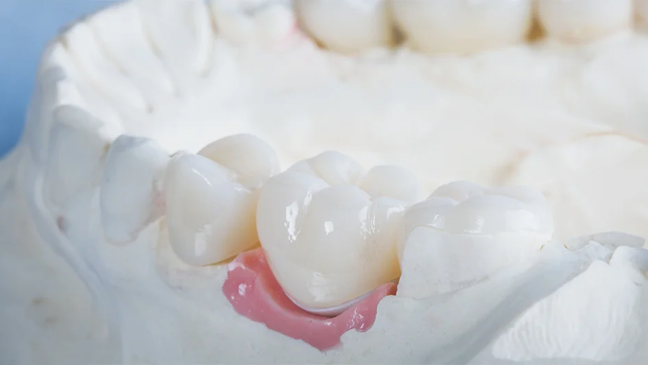 Traditional crown placement before implant crowns in West Vancouver