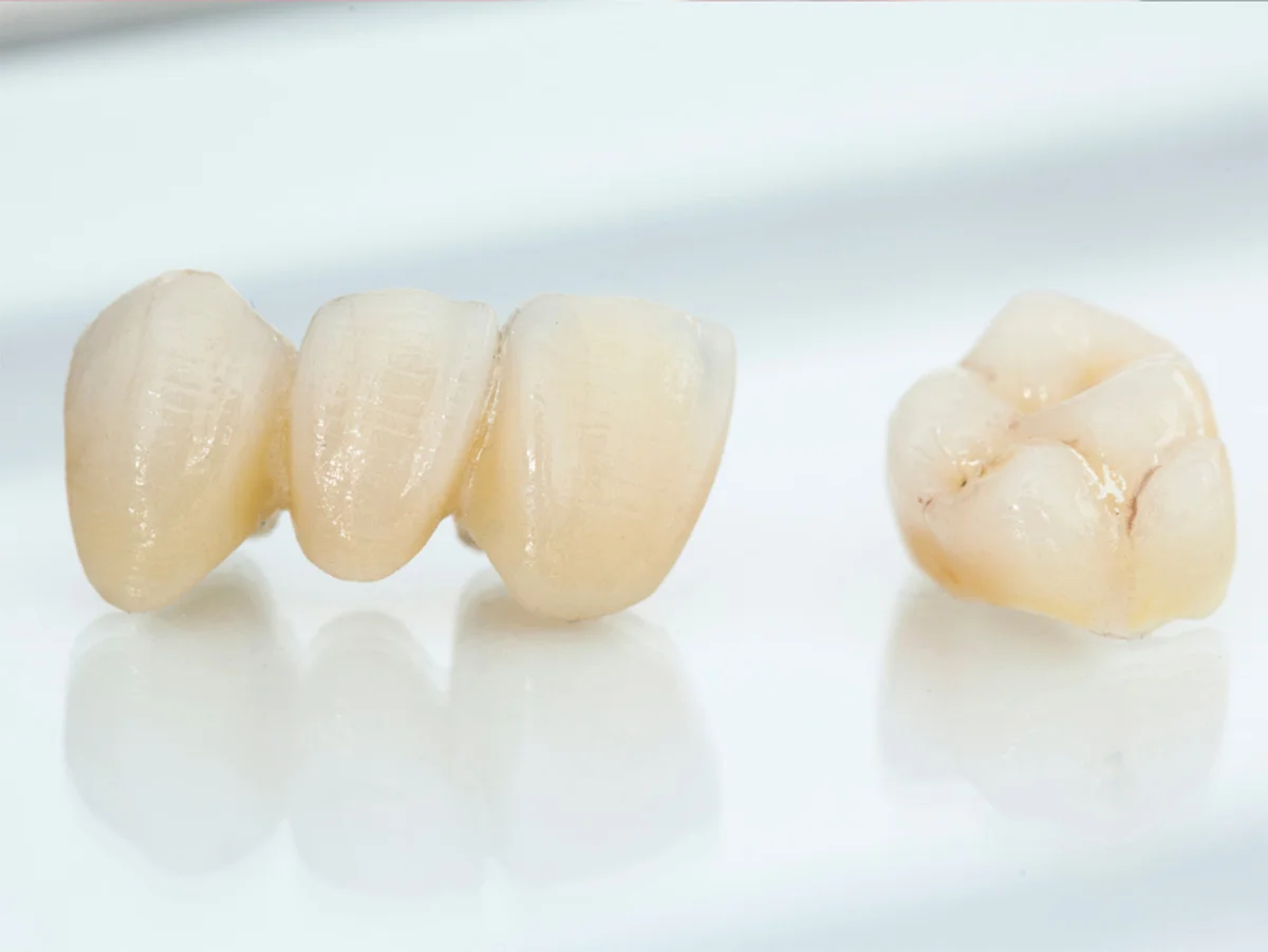 Implant Crowns image